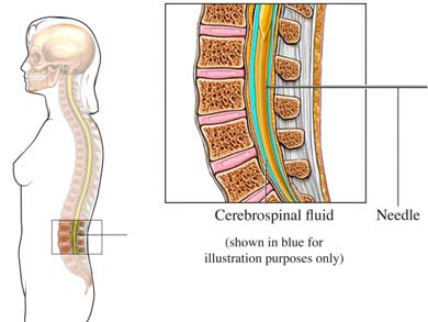 lumbarpuncture